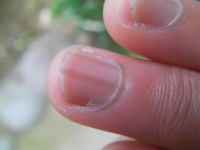 大拇指指甲上有竖纹是怎么回事 大拇指指甲上有黑色竖纹的原因 手指甲上有竖纹图解