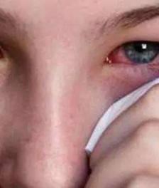 眼角痒是怎么回事 眼睛痒的几种原因